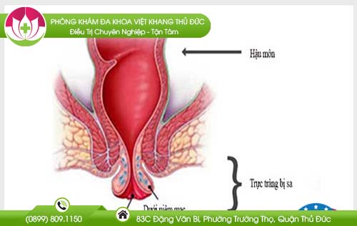 Bài thuốc chữa sa trực tràng