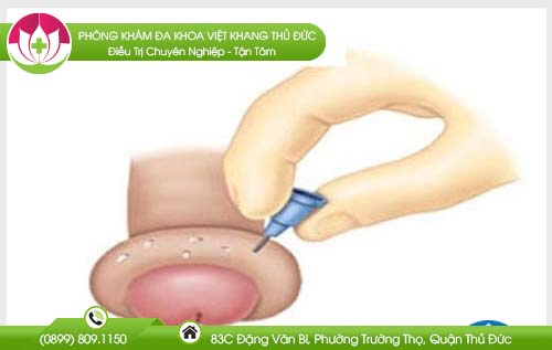 bao-quy-dau-bi-sung-mong-nuoc