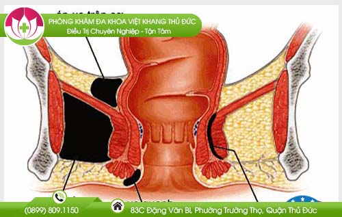 Bệnh apxe hậu môn nguy hiểm như thế nào?