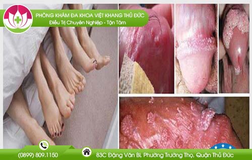 benh-sui-mao-ga-co-duoc-quan-he-khong
