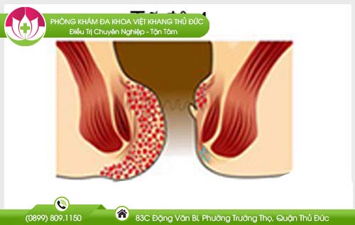 Bệnh trĩ cấp độ 4