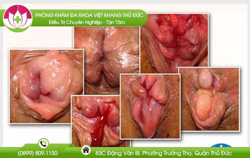 benh-tri-co-di-truyen-khong