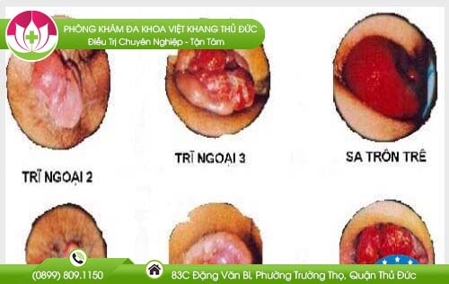 benh-tri-co-nguy-hiem-khong