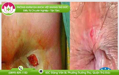 benh-tri-co-tu-khoi-khong