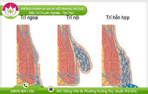 Bệnh trĩ là gì và cách phân loại bệnh trĩ