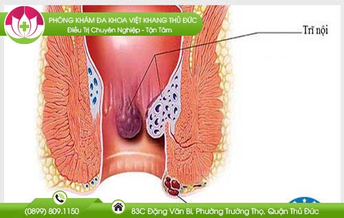 Bệnh trĩ lây qua đường nào?