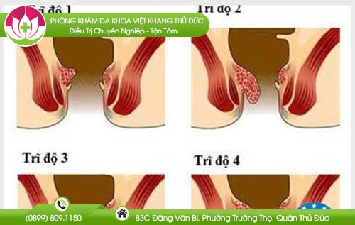Bệnh Trĩ - Nỗi đau khó nói