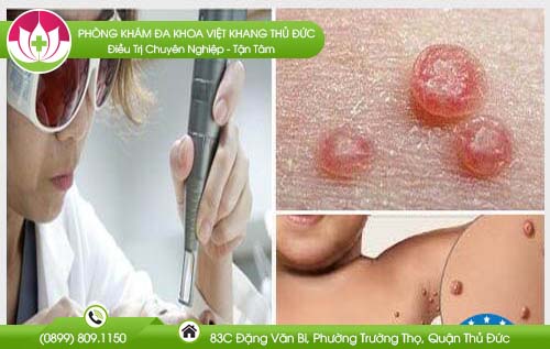 Tư vấn bệnh u mềm lây và cách chữa trị đạt kết quả cao nhất