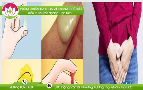 bi-huyet-trang-co-sao-khong