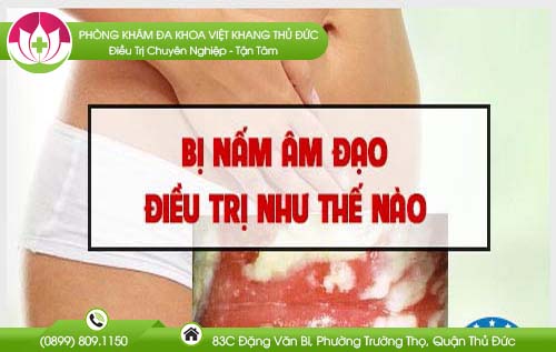 Bị nấm âm đạo điều trị như thế nào tại nhà an toàn và hiệu quả