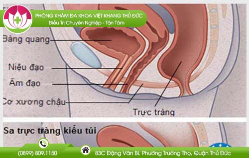 Bị táo bón do sa trực tràng kiểu túi
