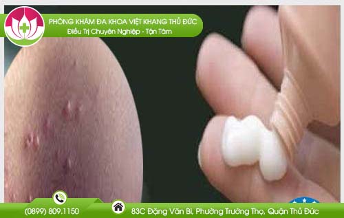 Bật mí bị u mềm lây bôi thuốc gì để nhanh khỏi nhất