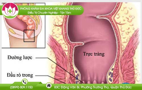 Biến chứng rò hậu môn