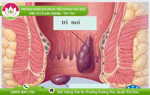 bieu-hien-cua-benh-tri-giai-doan-dau1