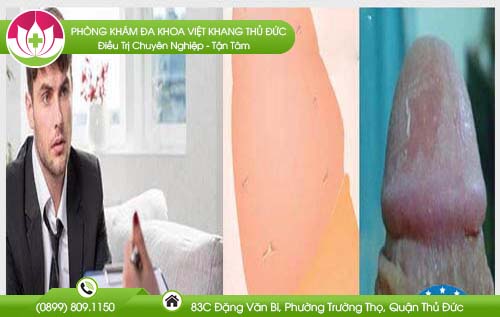 Tìm hiểu nguyên nhân gây bong tróc da bao quy đầu và cách chữa trị an toàn