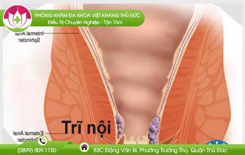 Búi trĩ nhỏ có cần chữa không, có nguy hiểm không?