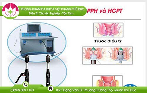 cac-cach-chua-ro-hau-mon-khong-can-phau-thuat