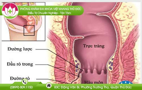 Các cách chữa rò hậu môn không cần phẫu thuật