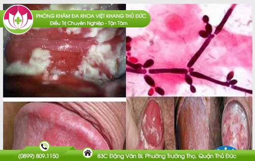 cach-chua-benh-nam-candida