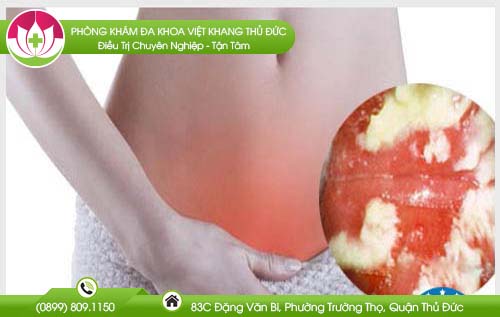 cach-dat-thuoc-phu-khoa-polygynax