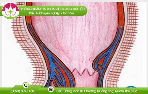 Cách nhận biết bệnh trĩ nặng nhẹ như thế nào?