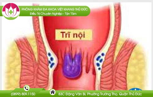 Cách nhận biết chính xác bệnh trĩ qua các triệu chứng