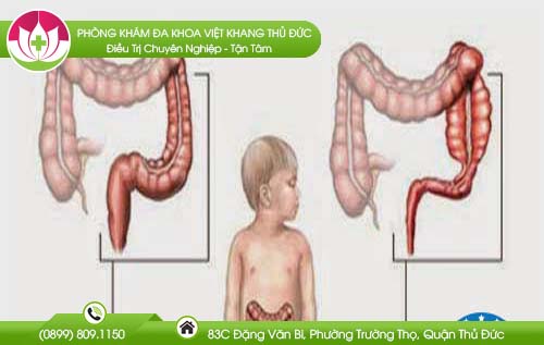 cach-nhan-biet-phinh-dai-trang-o-tre-nho