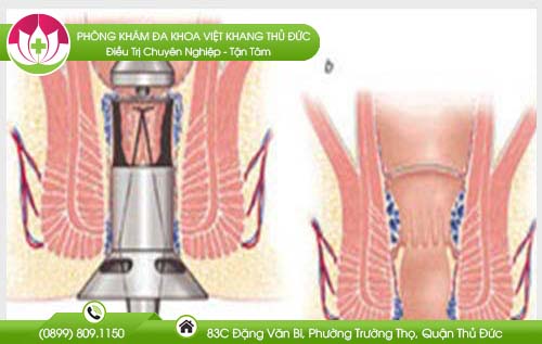 Cách trị bệnh trĩ hiệu quả nhất hiện nay là gì?