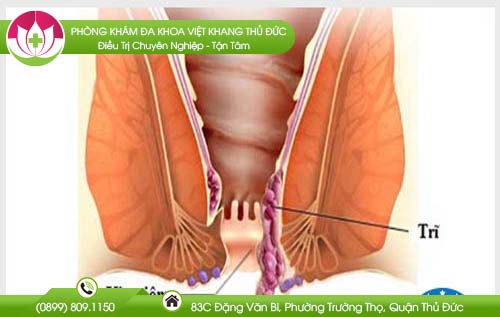 Chích xơ búi trĩ có đau không?
