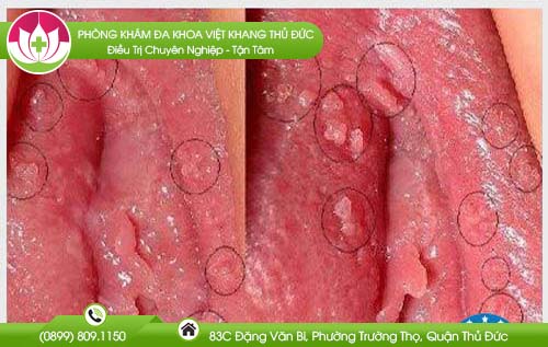 chua-benh-sui-mao-ga-co-dat-khong