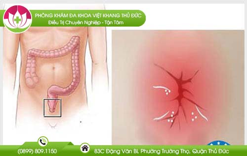 Chữa nứt kẽ hậu môn tại nhà