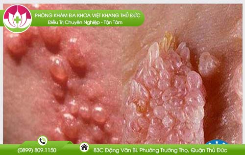 chua-sui-mao-ga-co-dat-khong