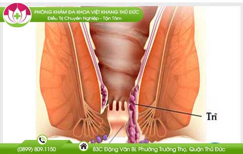 Chữa trĩ bằng phương pháp tiêm xơ búi trĩ