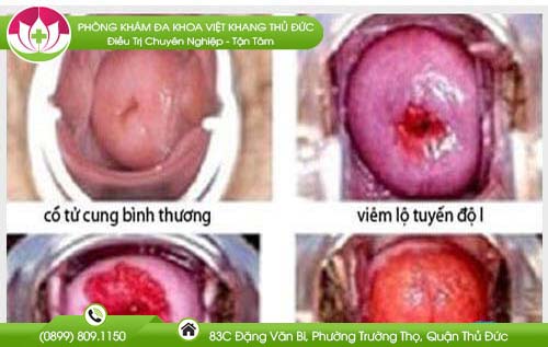 chua-viem-lo-tuyen-o-dau-tot