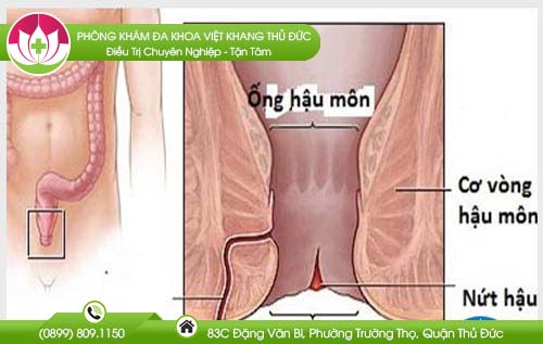 Có cách chữa nứt hậu môn tại nhà không?
