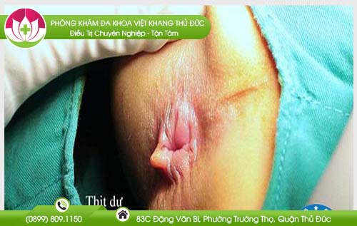 co-thit-du-o-hau-mon-co-nguy-hiem-khong