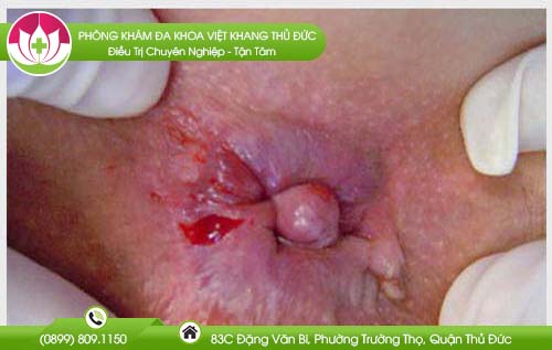 Có thịt dư ở hậu môn có nguy hiểm không?
