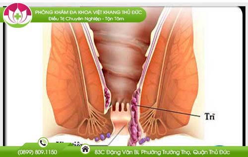 Dấu hiệu bị biến chứng tiêm xơ trĩ