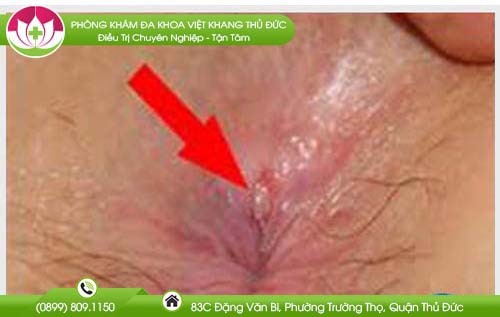 dau-hieu-bi-nut-hau-mon-va-hinh-anh-thuc-te