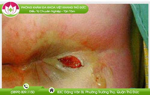 dau-hieu-bi-nut-hau-mon-va-hinh-anh-thuc-te