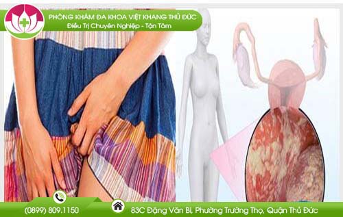 Dấu hiệu của bệnh nấm Candida ở nữ giới cần sớm phát hiện và xử lý