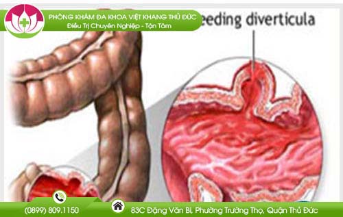 Đi cầu ra máu mà không đau là bị gì và cách khắc phục