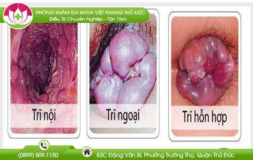Địa chỉ bệnh viện chữa bệnh trĩ ở Bình Thuận cắt trĩ an toàn không đau