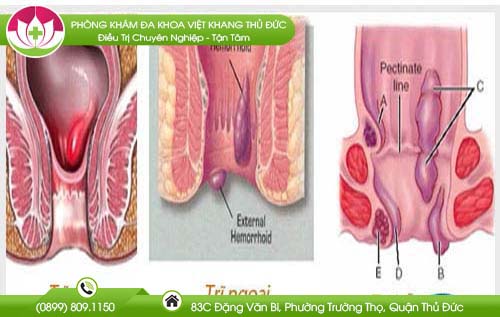 Địa chỉ bệnh viện chữa bệnh trĩ Huyện Củ Chi đẩy lui trĩ hỗn hợp nhanh chóng