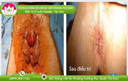 Tìm hiểu phương pháp và địa chỉ bệnh viện chữa bệnh trĩ quận 11