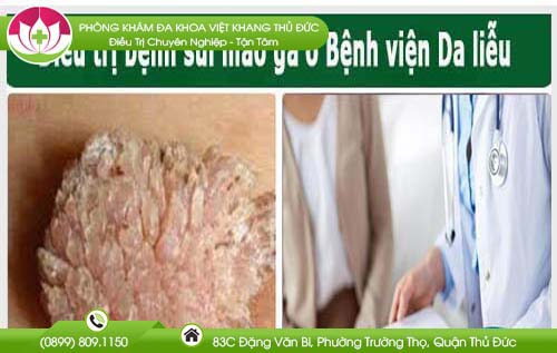 Khám và điều trị bệnh sùi mào gà ở bệnh viện da liễu có nên hay không?