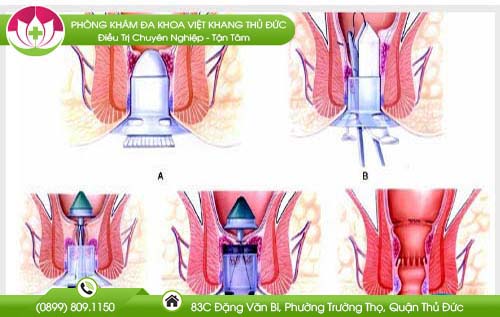 dieu-tri-benh-tri-mat-bao-nhieu-tien-tai-tphcm
