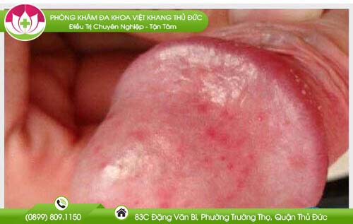 duong-vat-noi-mun-nuoc