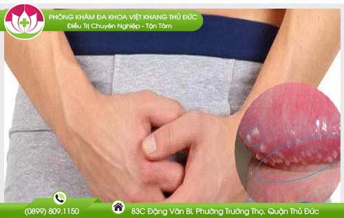 Dương vật nổi mụn nước