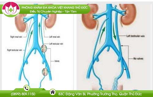 gian-thung-tinh-hoan